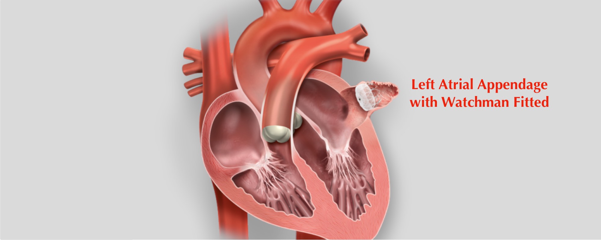 post watchman procedure icd 10